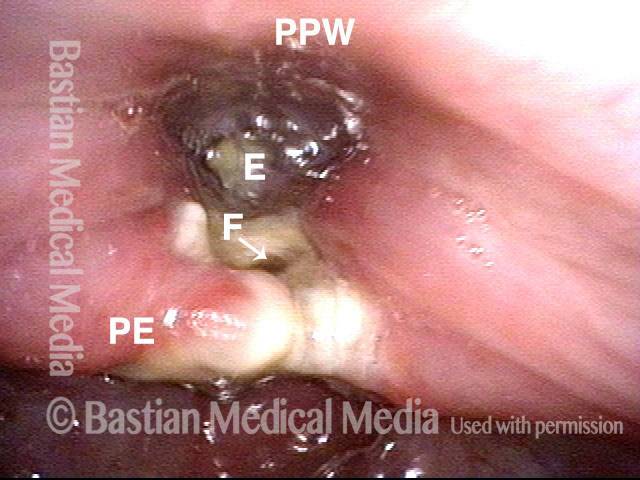 Pharyngocutaneous fistula