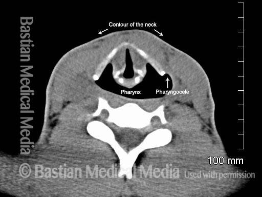 Pharyngocele: view at vocal cord level