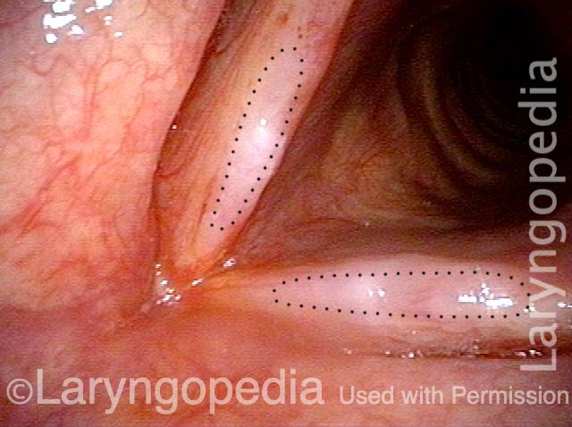 mucosal excision