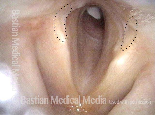 Distant view of vocal cords
