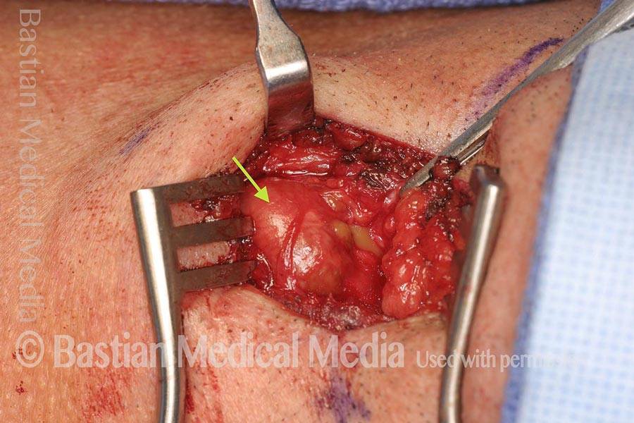 Lateral saccular cyst removal, external approach