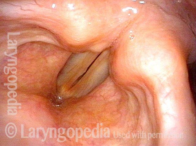 Distant view of right vocal cord