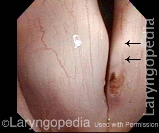 At the conclusion of the laser procedure
