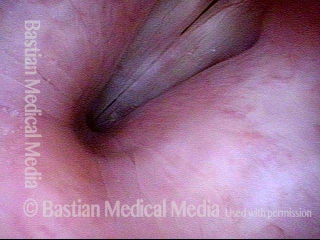 Vocal polyp, surgically removed