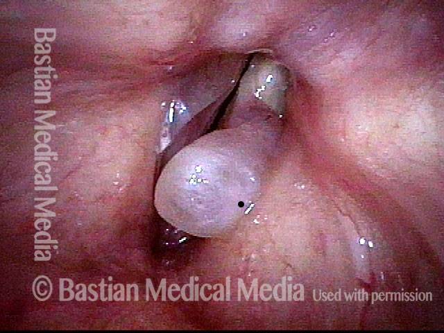 Edematous tissue causes a rough voice