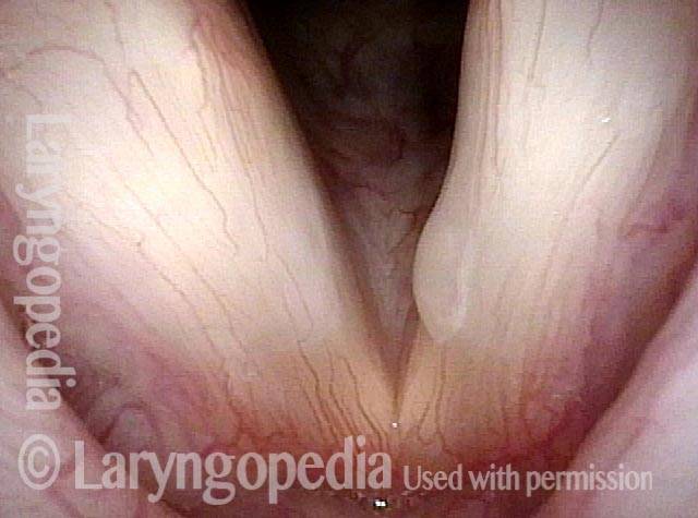 Vocal cord polyp
