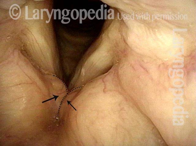 Are cysts the main issue?