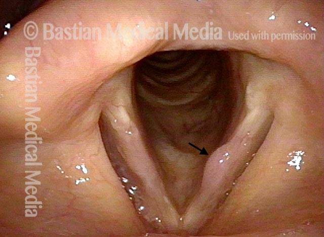 Left vocal cord lesion