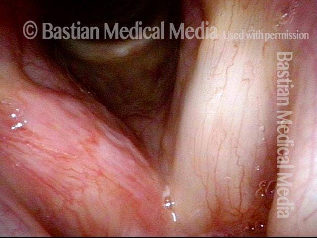 Vocal cords a week after second removal of papillomas and cidofovir injection