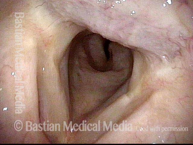 Upper tracheal stenosis, before repair