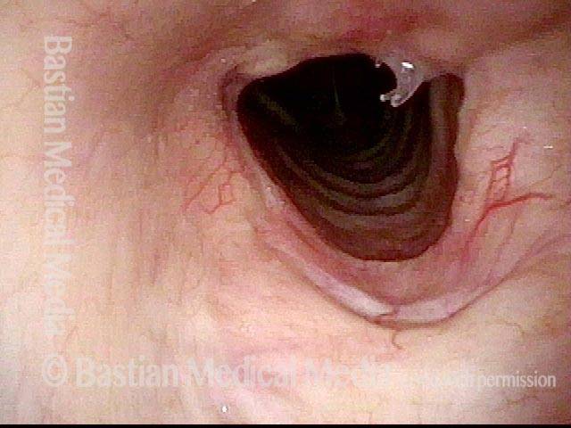 After tracheal repair
