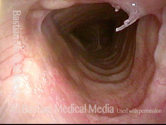 After tracheal repair