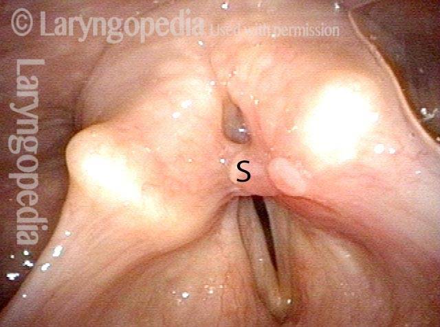 Laryngeal stenosis post intubation