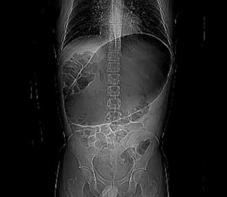 X-Ray of Abdominal Bloating