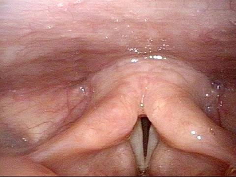vocal cord Aperture is very narrow