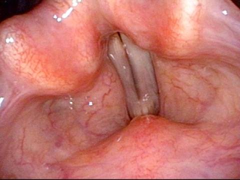 Left vocal cord adducts normally