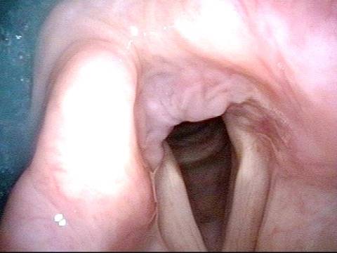 right vocal cord paresis