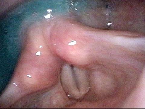 Vocal cord is paretic, not paralyzed