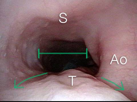Esophagus stretches laterally due to trapped air
