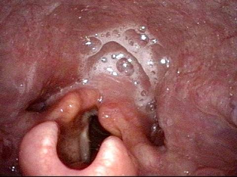 Pooling of saliva is seen in the post-arytenoid area.