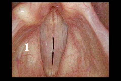 During voicing, healthy larynx.