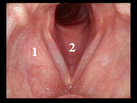 the larynx during acute laryngitis