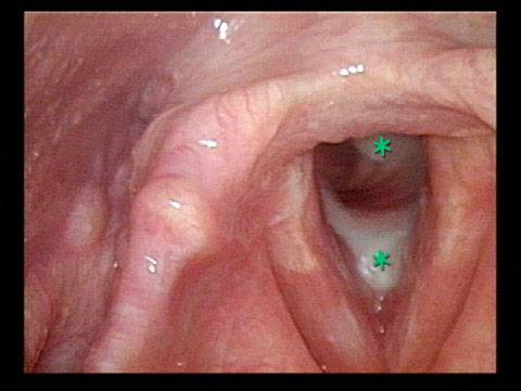 A cough brings copious secretions to the subglottis and trachea