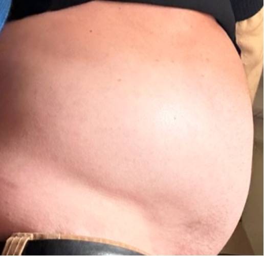 Bloating before botox injection