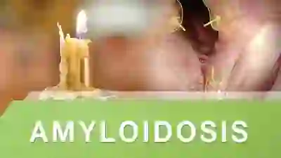 amyloidosis YT Thumbnail