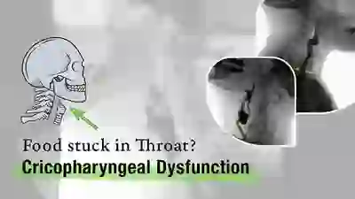 Food stuck in throat due to cricopharyngeal dysfunction seen by VFSS YT Thumbnail