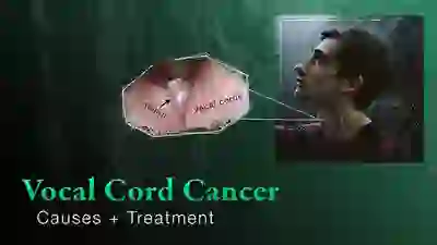 Vocal cord cancer YT Thumbnail