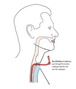Illustration of a person with a red rubber catheter inserted through a laryngectomy person’s trachea-esophageal fistula