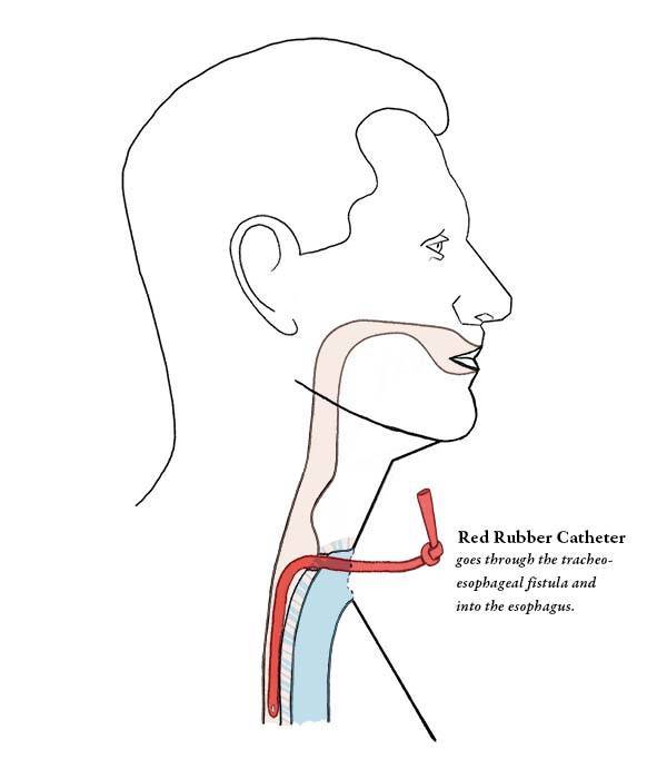 Illustration of a laryngectomy patient and how a red rubber catheter is inserted through the fistula into the esophagus to prevent it the fistula from closing when the TEP is not present.