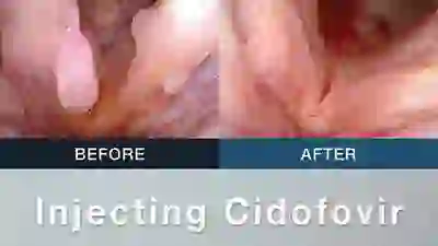 injecting cidofovir YT Thumbnail