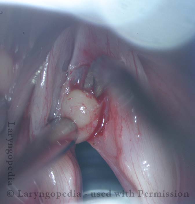 At anterior curve of the cyst, left-turning scissors are dissecting at the layer between cyst wall and its attachments.
