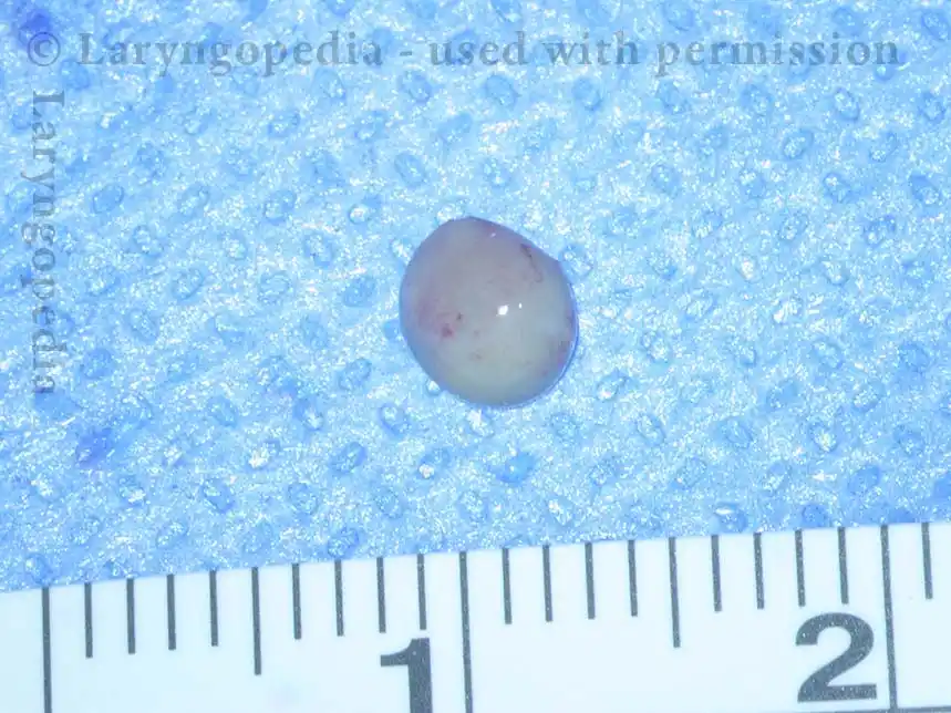 Intact cyst, measures about 4mm in diameter