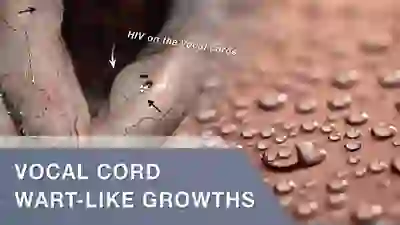 vocal cord wart-like growths YT Thumbnail