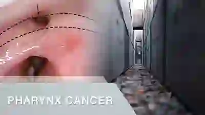 pharynx cancer YT Thumbnail