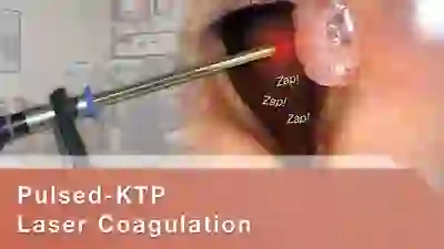 pulsed-KTP laser coagulation YT Thumbnail