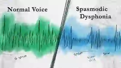 Normal voice compared to Spasmodic Dysphonia YT Thumbnail