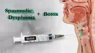 Spasmodic Dysphonia and Botox YT Thumbnail