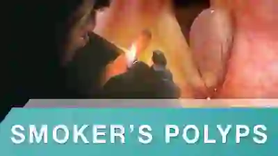 smokers polyps YT Thumbnail
