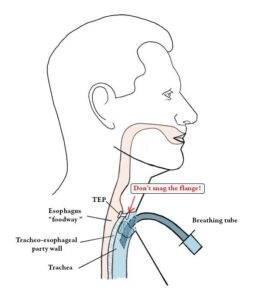Illustration of how a breathing tube should be inserted without snagging the TEP flange into the trachea of a laryngectomy person