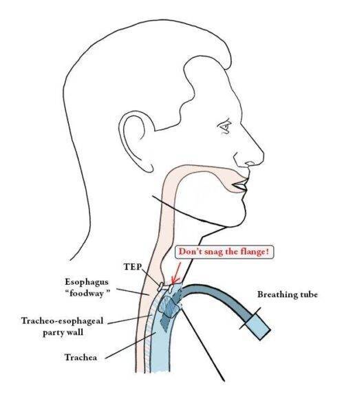 Visiting the Hospital as a Laryngectomy Patient