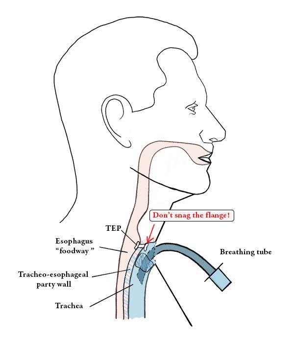 Illustration of breathing tube in a laryngectomy patient and how you must make sure it does not snag the TEP when inserting into the trachea.