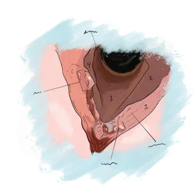 Illustration of vocal cord caner