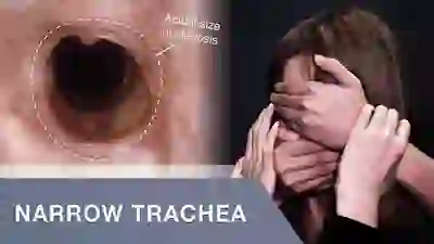 narrow trachea YT Thumbnail