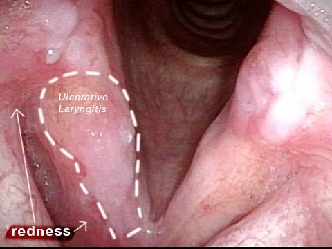 A hazy white area on the right vocal cord