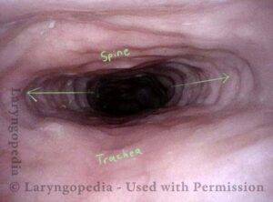 dilation of the upper esophagus