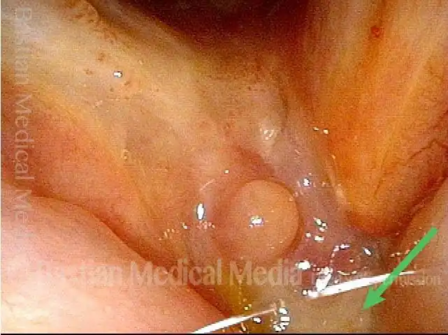 residual exposed cartilage, not yet healed over with mucosa